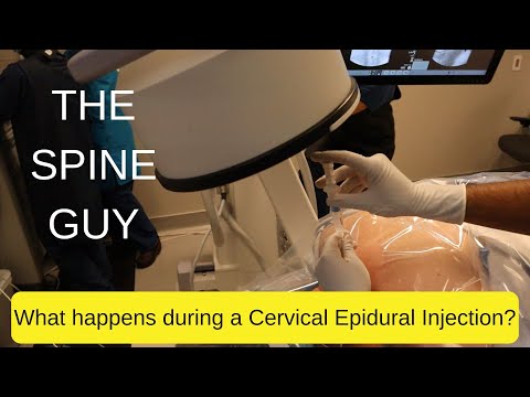 What Happens During a Cervical Epidural Steroid Injection?