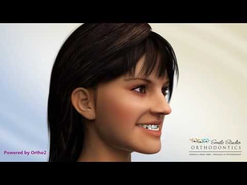 LeFort 1 Advancement