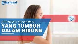 Polip Hidung, Jaringan Abnormal yang Tumbuh pada Bagian dalam Hidung Menyerupai Bentuk Anggur