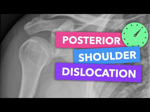 Posterior shoulder dislocation - Radiopaedia Emergency Radiology Course