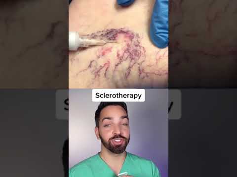 TREATING SPIDER VEINS #shorts