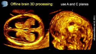 3D scan of the fetal brain at 11-13 weeks gestation
