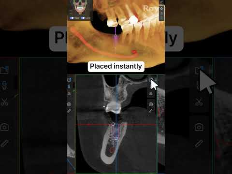 SMARTDent : 5D Tutorial #3-2. Implant Placement in Seconds