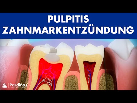 , title : 'Pulpitis – Zahnmarkentzündung ©'