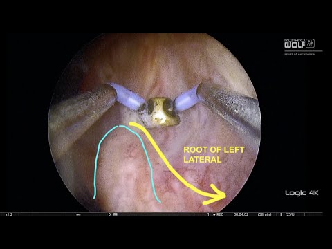 Step 1-  Identification of the capsule BIPOLAR ENUCLEATIO...