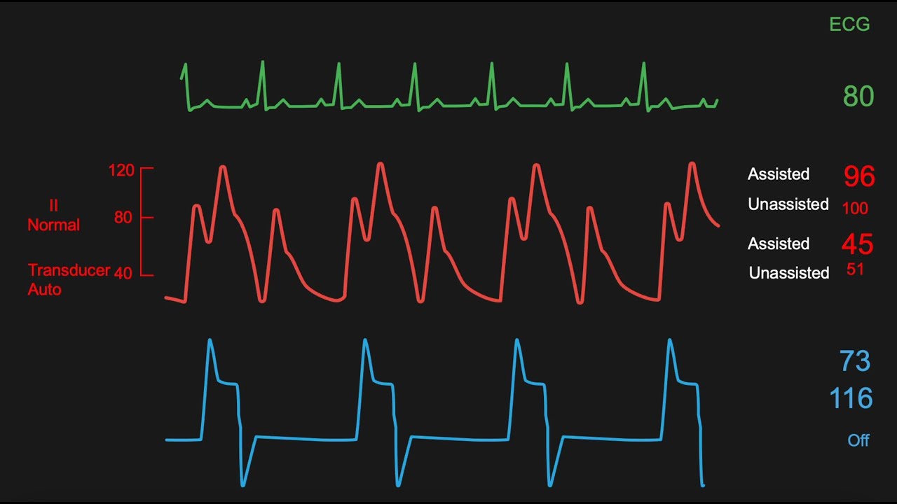 Interpreting the data displayed on a balloon pump console monitor