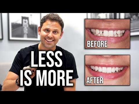 Less is More (Peg Laterals) - Dental Science