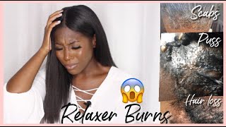 Nasty 🤢 Relaxer Burns !? 10 Tips On Preventing Them ❗MUST SEE❗| Relaxed Hair