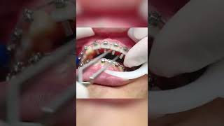 Braces Learning - Adding Bite Turbos/Bite Blocks w/ The Braces Doc