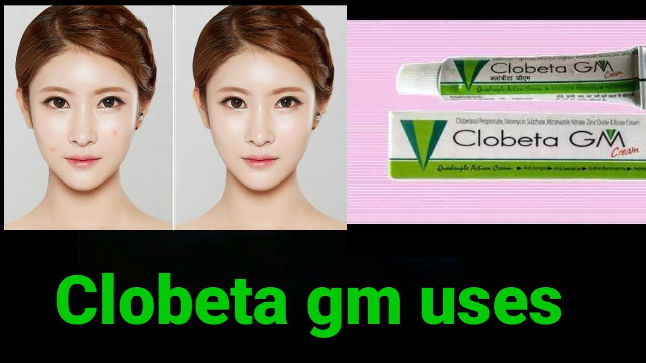 Clobeta gm cream uses in telugu best cream for beauty