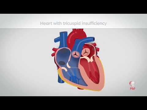 TRICVALVE   Transcatheter Bicaval Valves System