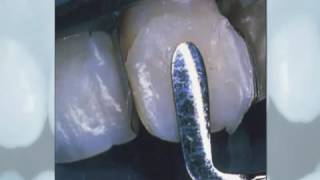 Tooth colored restoration