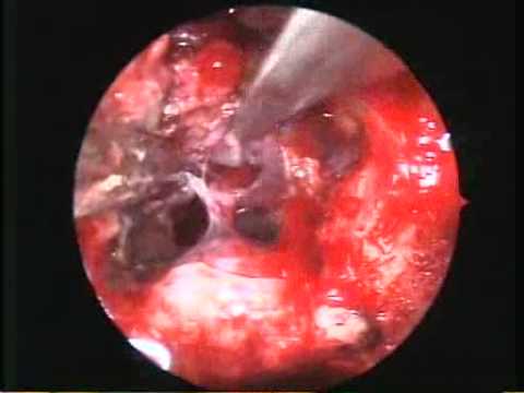 Endoscopic extended approach for tuberculum sellae meningioma