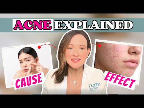 Your Ultimate Acne Treatment Guide  Causes and Effective Solutions 1