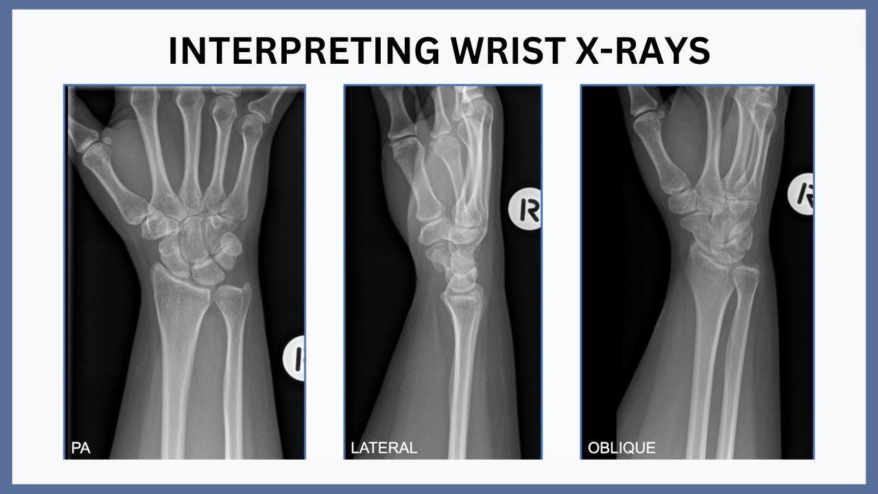 Interpreting Wrist X-Rays