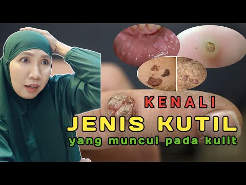 jenis jenis KUTIL yang harus kamu ketahui. apakah kutil berbahaya?