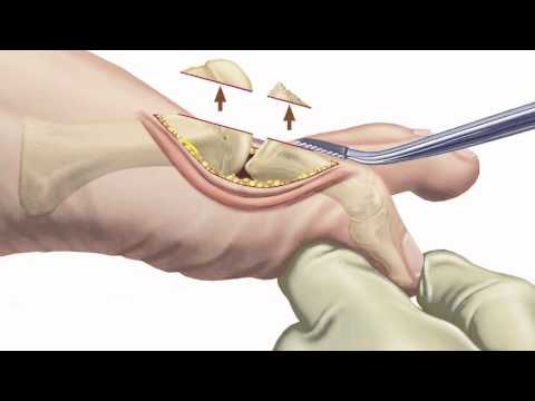 A csípőízület deformáló artrózisa 3 stádiumú kezelés