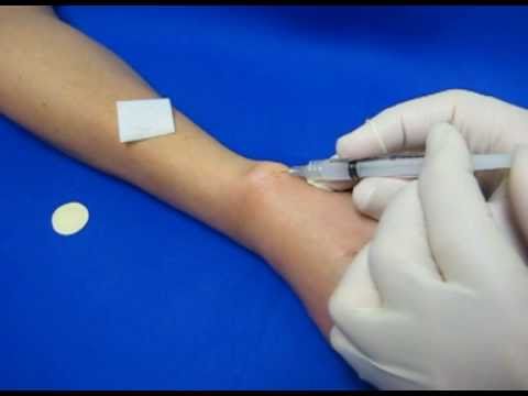 De quervain syndrome steroid injection