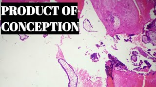 Product Of Conception