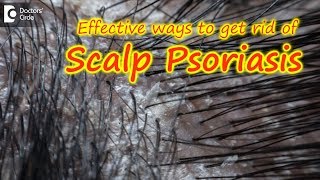 Scalp psoriasis:Symptom, Cause, Treatment | Safe ways to Wash Hair -Dr. Rasya Dixit| Doctors