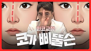 휜코교정술, 재발 없이 잡는 방법 총정리ㅣ비티성형외과