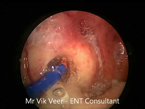 Balloon Eustachian Tube Treatment