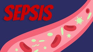 Actualización Sepsis