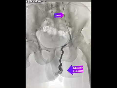 Varicocele Embolisation Angiography (venogram) of left gonadal vein in a man suffering from