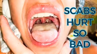 DON&#39;T EVER LOOK IN SOMEONE&#39;S MOUTH AFTER TONSIL SURGERY | SCABS SCRAPE THE THROAT  *2019