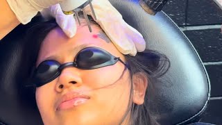 Victoria Laser Tattoo Removal At The Ink Eraser Session 1