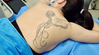 Process of Removing Bad Tattoo. Laser Tattoo Removal Korean Doctor