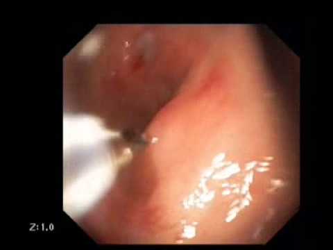 Duodenal Ulcer Clipping