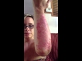 Psoriasis Hell Part 2 