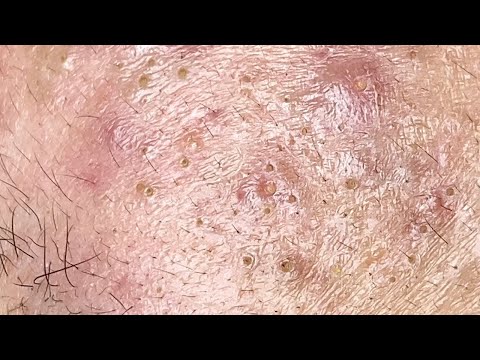 Deep clogged pores extracted! Blackhead and Acne Removal