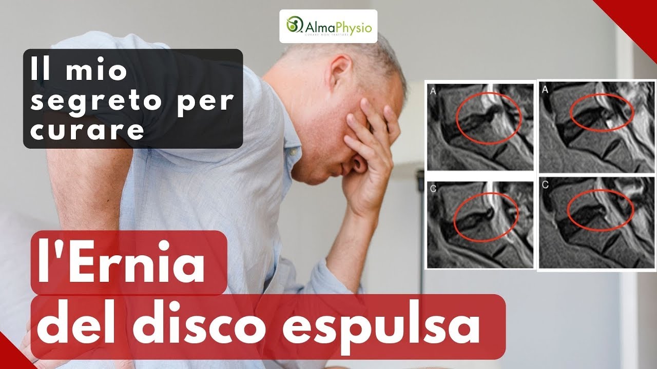 Il mio segreto per curare (definitivamente!!!) l'ernia del disco espulsa