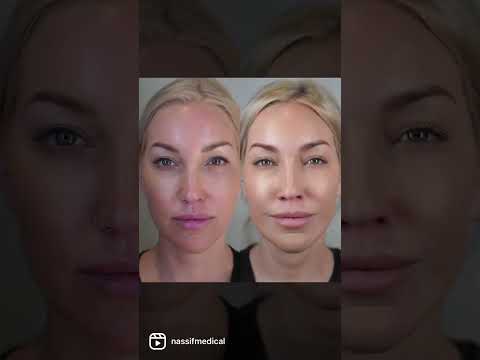 VI Peel | Dr. Paul Nassif