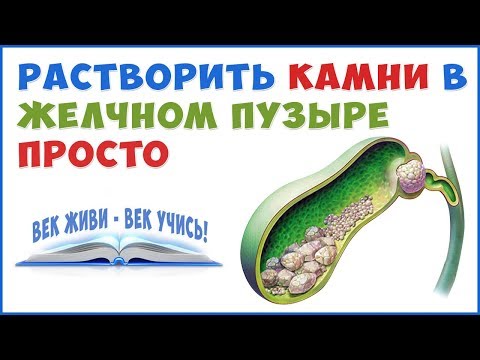 Как растворить Камни в Желчном Пузыре и Печени без операции!