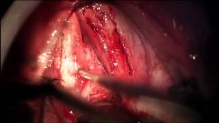 CIRUGÍA LÁSER EDEMA DE REINKE