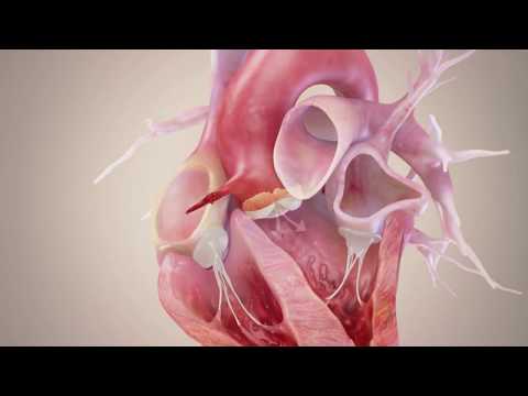 Bicuspid Aortic Valve, Anatomy and Potential Complications