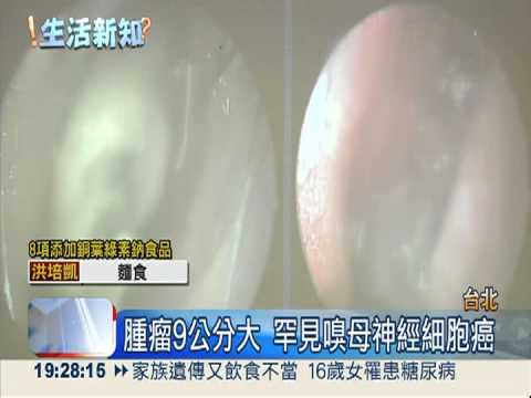 流鼻血竟罹癌! 男失嗅覺險失明