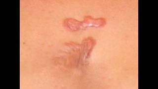 Decubitus Ulcers - Massage Pathology