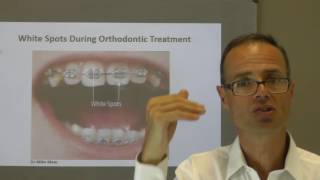 White Spots During Orthodontic Treatment by Dr Mike Mew