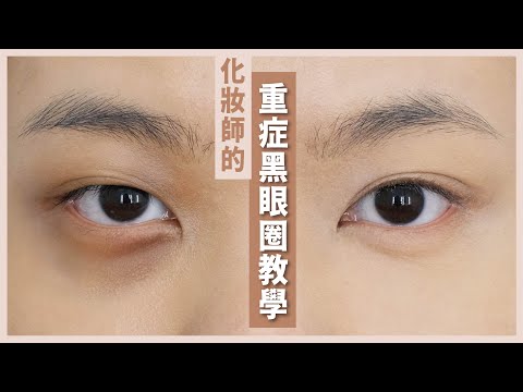 眼尾發黑