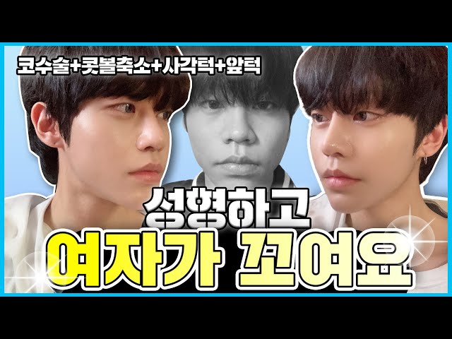 더 예쁘게, 에이비성형외과 이벤트 더 예쁘게, 에이비성형외과 이벤트
