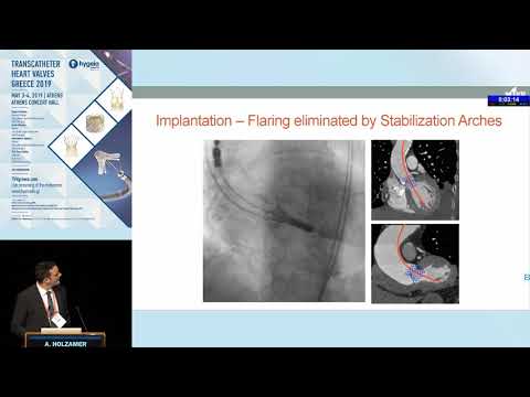 A. Holzamer  | The ACCURATE Neo TAVR system. Program Update, clinical data, patient selection and...