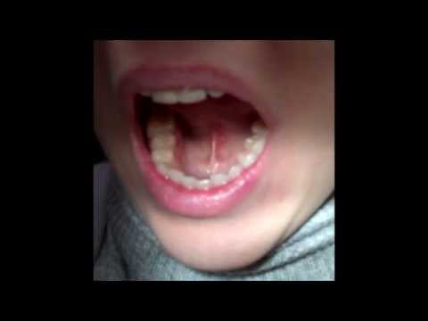 comment soulager aerophagie