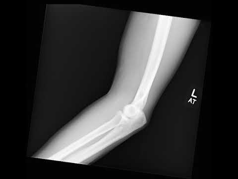 Elbow X-Ray in Motion