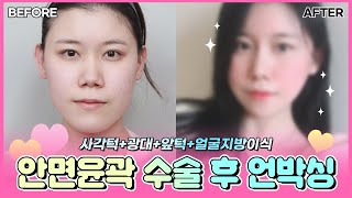 안면윤곽 전후, 회복과정 리얼 언박싱 영상!! (사각턱, 광대, 턱끝+얼굴 지방이식) 얼굴 라인에 감동..????