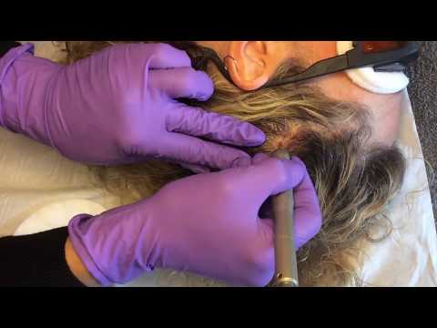 Comfortable Mole Removal on the Scalp in Brighton and Hove with Dual Yellow Laser Treatment.