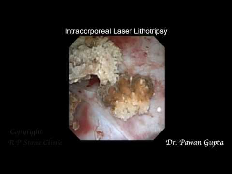 Multiple Kidney Stones Treated By RIRS